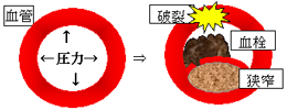 動脈硬化の模式図