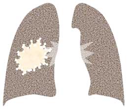 肺炎の模式図